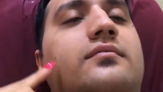برداشتن خال صورت