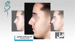 جراحی بینی آقایان