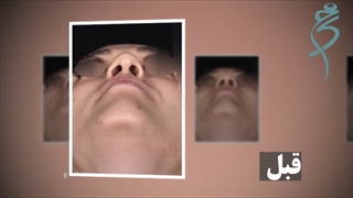 نمونه جراحی بینی