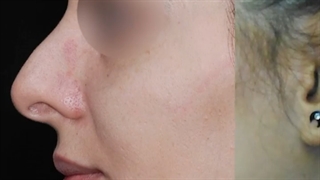 جراحی بینی غضروفی به صورت نیمه فانتزی
