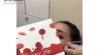 فیلم تزریق پی آر پی صورت