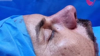 فیلم اتاق عمل، جراحی بینی مردانه