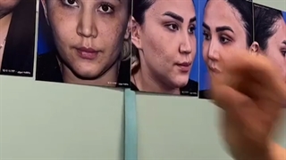 فیلمی از اتاق عمل، جراحی بینی فانتزی در تهران
