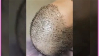 افزایش تراکم یا پرپشت شدن موی سر با روش های مدرن و خانگی