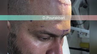 کاشت مو گرگان ، ۰۹۳۳۶۰۹۳۰۰۰ مرکز تخصصی پیوند مو