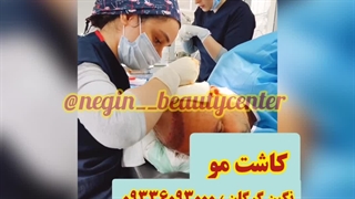 کاشت مو در گرگان، مراجعه کننده از سمنان، نگین گرگان 01732536278