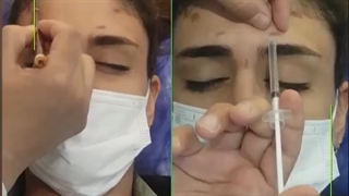 فیلم واقعی و بدون سانسور از تزریق بوتاکس به پیشانی