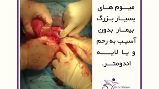 فیلم جراحی فیبروم و میوم بدون آسیب به رحم و آندومتر | دکتر مهتاب مرجانی