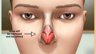 انیمیشن جراحی بینی