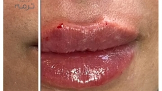 تزریق ژل لب طبیعی