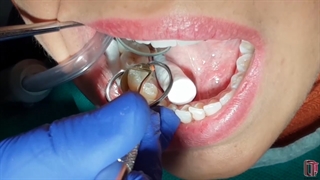 فرم دادن مارجینال ریج در ترمیم های کلاس II کامپوزیت