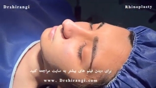 مراحل جراحی زیبایی بینی توسط دکتر سعید شیرنگی