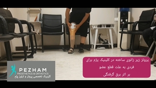 قیمت پروتز پا زیر زانو - مرکز ساخت انواع پای مصنوعی - کلینیک پژم