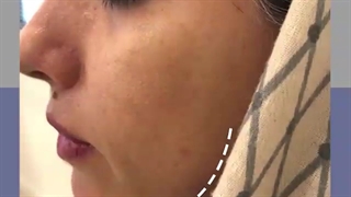 تزریق فیلر گونه و زاویه فک با نتیجه کاملا طبیعى