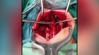 تترد کورد ستون فقرات گردنی