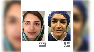 فیلم قبل و بعد جراحی پلک بالا