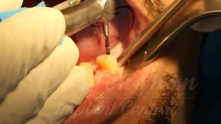 کاشت سه واحد ایمپلنت