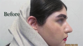 فیلم واقعی و بدون سانسور از اتاق عمل جراحی بینی