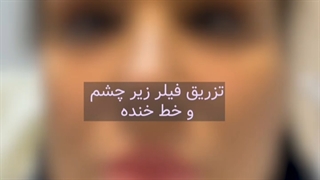 تزریق فیلر زیر جشم و خنده دندان شیری