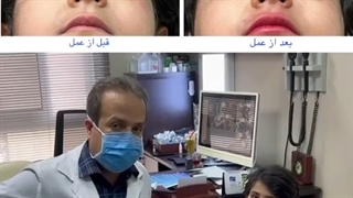 جراحی شکستگی کاسه چشم بر اثر تصادف