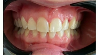 فیلم واقعی از کامپوزیت دندان