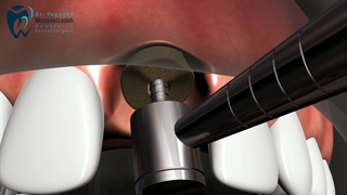 همه چیز درباره ی ایمپلنت دندان