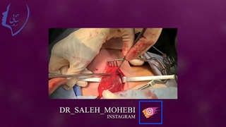 توده گردنی کیستیک