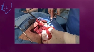 لنفانژیوم گردنی