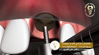 آیا جراحى ایمپلنت با مصرف سیگار تداخل دارد؟