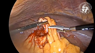 فیستول کیسه صفرا به روده بزرگ