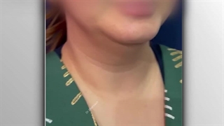 جراحی ساکشن گردن | دکتر خوروش