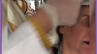 عوارض ، هزینه و مزایای تزریق ژل به شقیقه