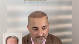 زیباجوی کاشت مو از کشور آلمان