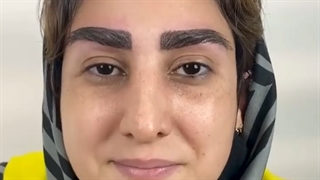 ⚜️کاشت ابرو با تراکم ‌بالا ⚜️