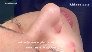 بهترین فوق تخصص رینوپلاستی در تهران