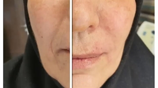 تـزریق فیلر برای بهبود چروک های اطراف دهان (خط خنده.خط اندوه.خطوط لب)