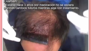 قدم به قدم با کاشت موی طبیعی | نتیجه نهایی کاشت مو چه زمانی است؟