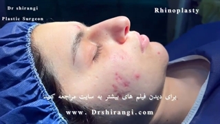 نحوه جراحی رینوپلاستی (جراحی بینی) در مطب دکتر شیرنگی