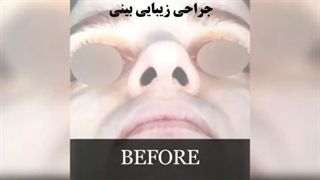 نتیجه عمل بینی بعد از 6 ماه