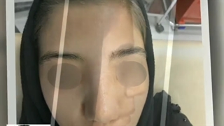 نتیجه جراحی بینی با انحراف شدید و مشکلات ساختاری