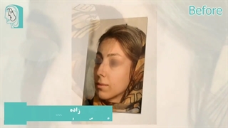 قبل و بعد جراحی بینی نیمه فانتزی