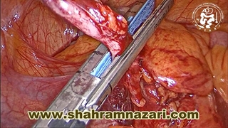 آپاندکتومی لاپاروسکوپی