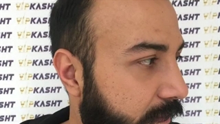 نتیجه عالی دو سال بعد از کاشت مو-کلینیک vip