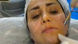 هزینه مدلینگ صورت با تزریق چربی به صورت-کلینیک vip بلیچینگ دندان