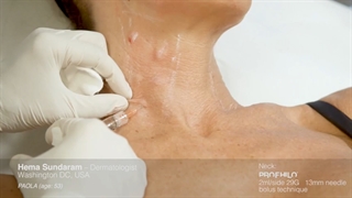 آموزش تزریق پروفایلو به گردن