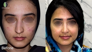 عمل زیبایی بینی | دکتر باستانی نژاد