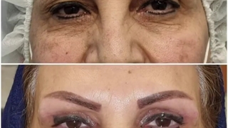 بلفاروپلاستی پلک فوقانی