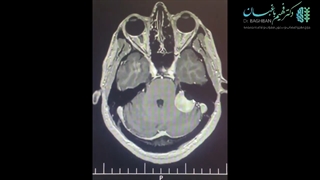 جراحی تومور سی پی انگل