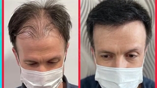 نمونه کاشت مو مراجعه کننده به کلینیک ترانسپلنت