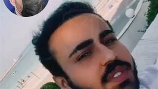 کاشت مو مسافر لبنانی در کلینیک ترانسپلنت